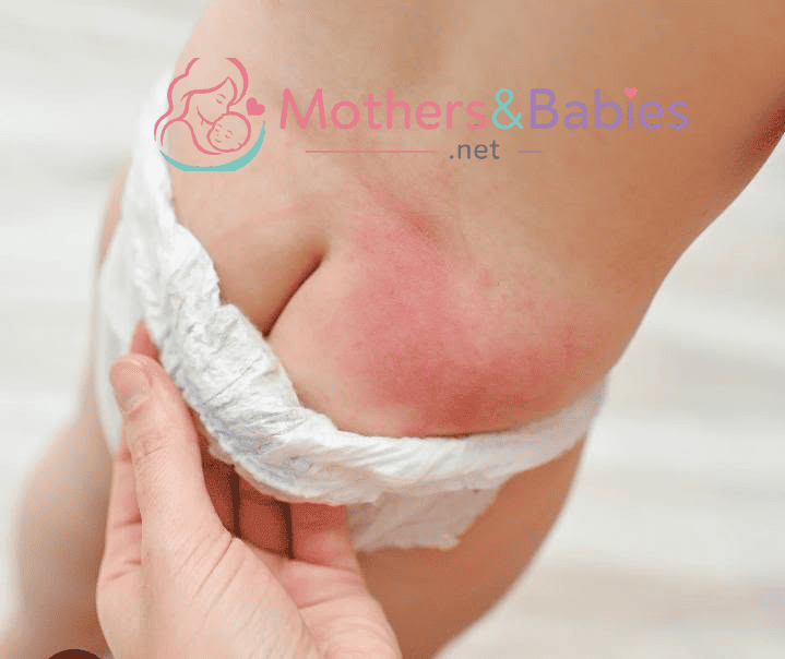 Best Diaper Rash Cure